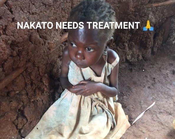 VIDEO : She requires assistance: In Busoga, a five-year-old child known as "Nakato" does not walk or talk.